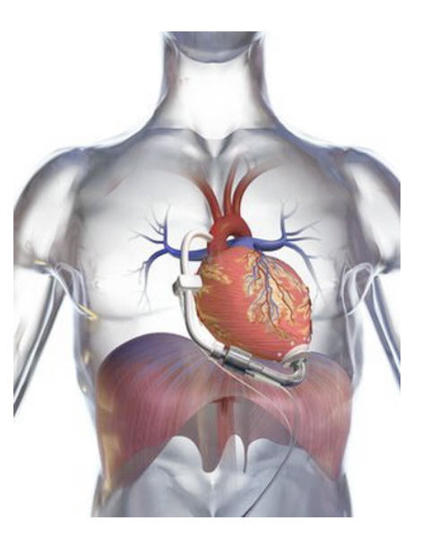Первое в мире механическое сердце представили врачам в Киеве (ФОТО)