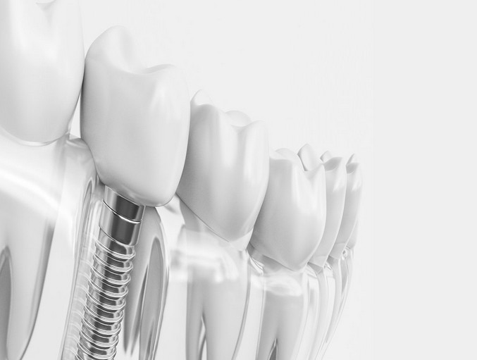 Имплантация зубов: современные технологии